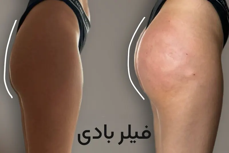 فیلر بادی 