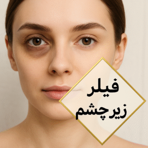 فیلر زیر چشم
