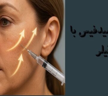لیفت میدفیس با فیلر
